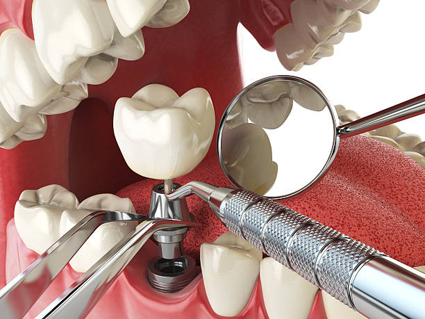 Best Broken or Cracked Tooth Emergency Dentist in Minden, NE